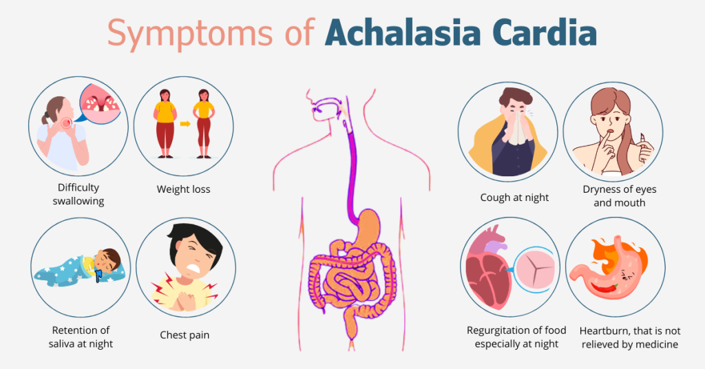 symptoms of achalasia-cardia