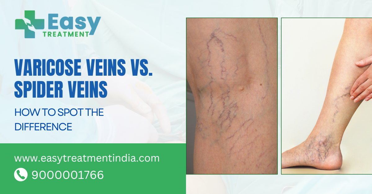 Comparison of varicose veins and spider veins on legs highlighting differences in size, color, and appearance.