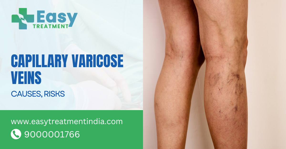 Capillary varicose veins on the legs, illustrating the web-like appearance and discoloration of spider veins.